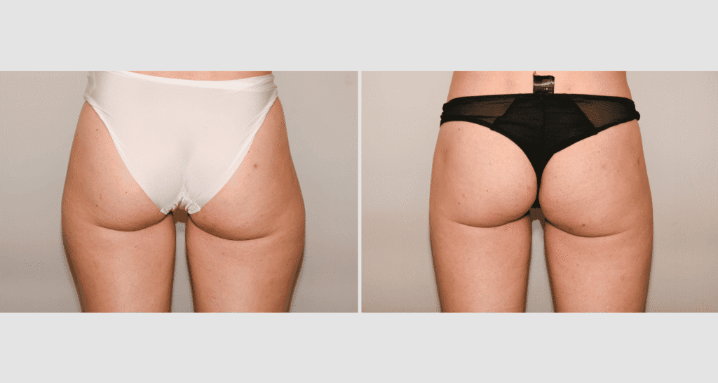 Vorher/Nachher Ergebnis: Fettabsaugung Reiterhosen
