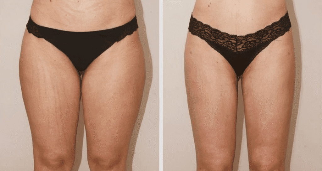 Vorher/Nachher Ergebnis: Fettabsaugung Reiterhosen