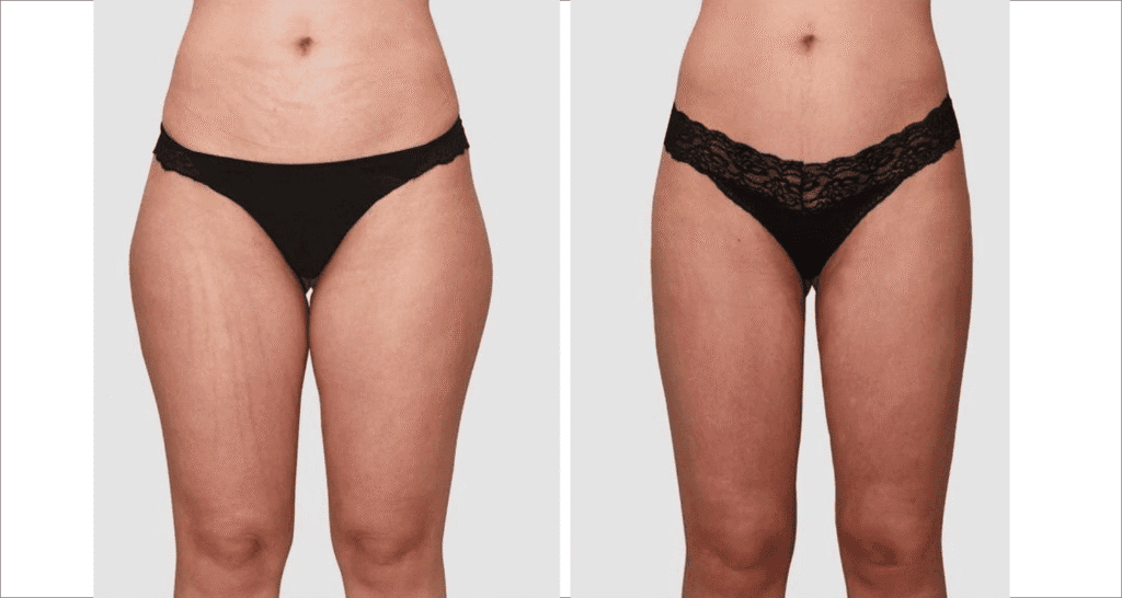 Vorher/Nachher Ergebnis: Fettabsaugung Reiterhosen