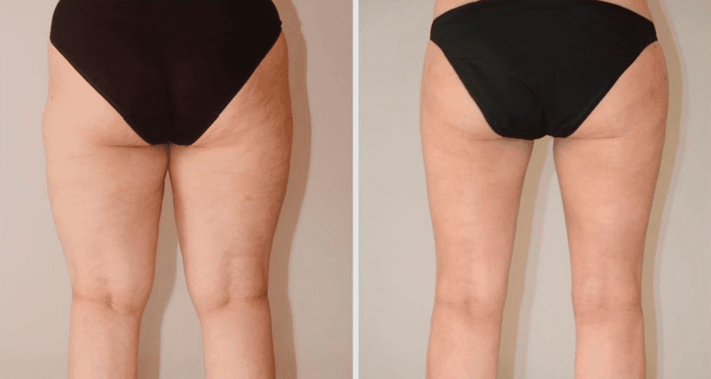 Vorher/Nachher Ergebnis: Fettabsaugung Reiterhosen