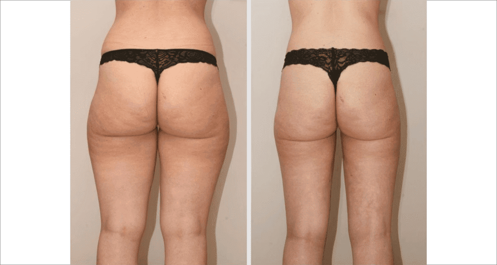 Vorher/Nachher Ergebnis: Fettabsaugung Reiterhosen