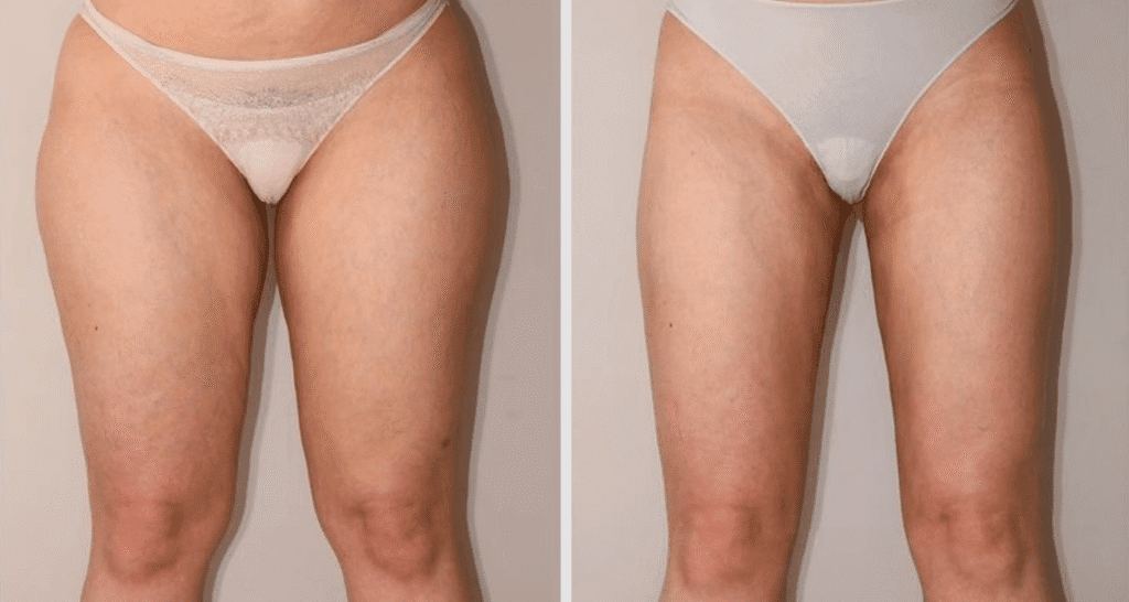 Vorher/Nachher Ergebnis: Fettabsaugung Reiterhosen