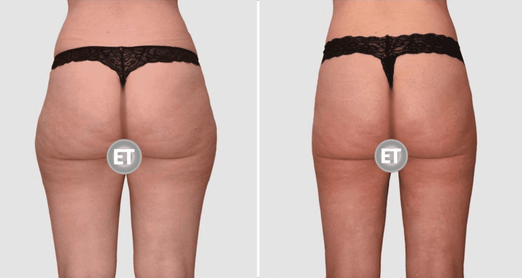 Vorher/Nachher Ergebnis: Fettabsaugung Reiterhosen