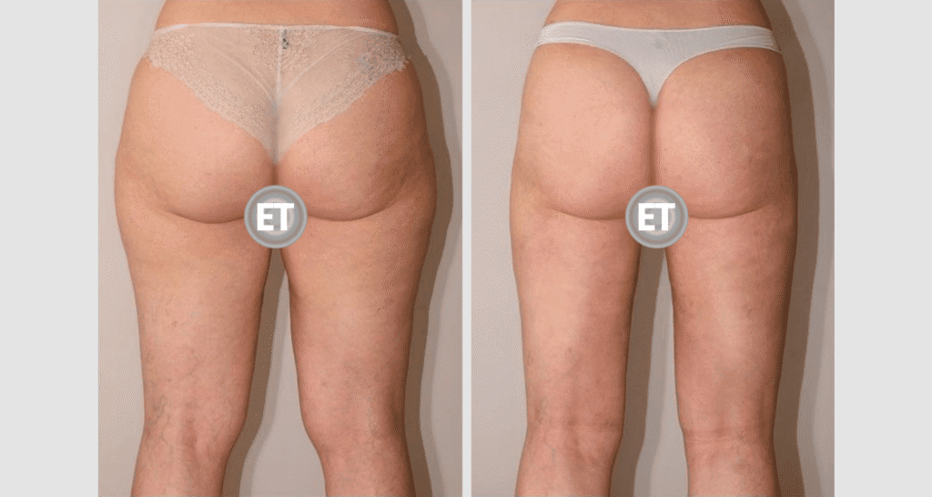 Vorher/Nachher Ergebnis: Fettabsaugung Reiterhosen