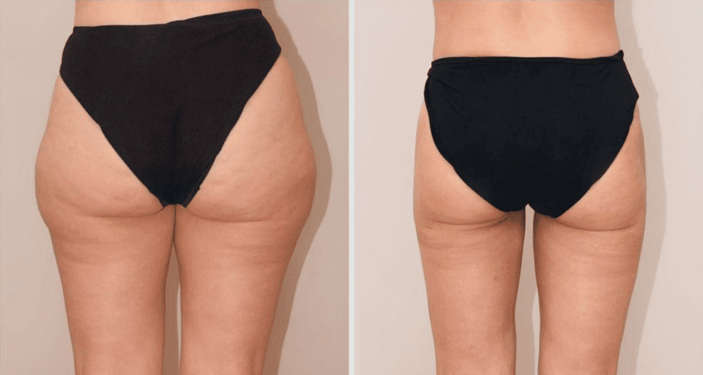 Vorher/Nachher Ergebnis: Fettabsaugung Reiterhosen