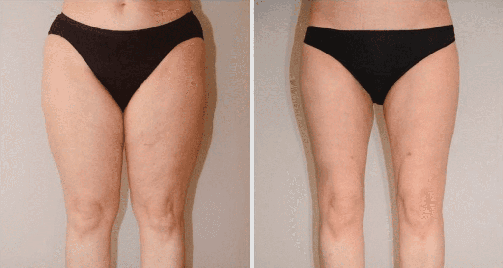 Vorher/Nachher Ergebnis: Fettabsaugung Reiterhosen