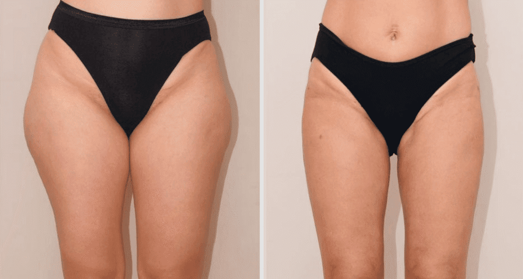Vorher/Nachher Ergebnis: Fettabsaugung Reiterhosen