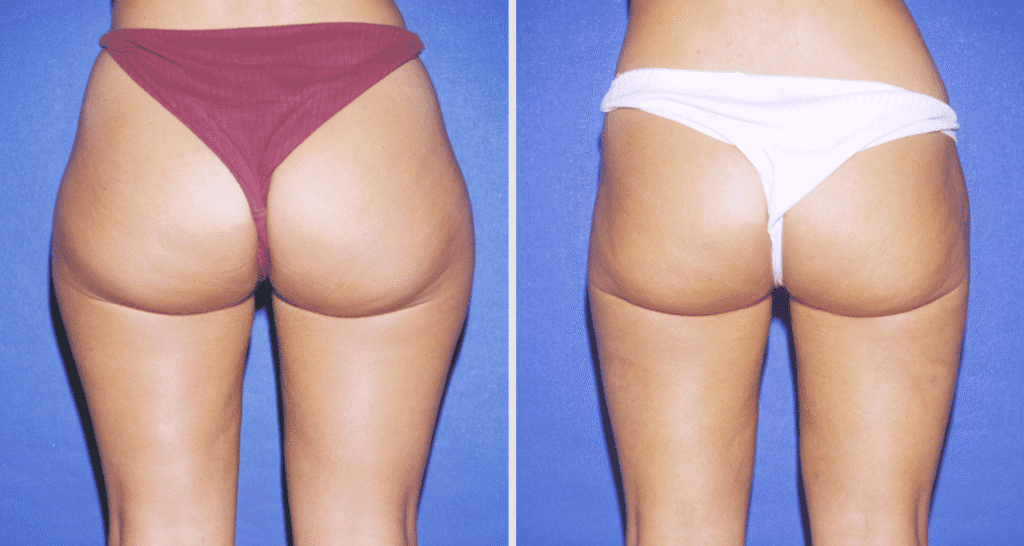 Vorher/Nachher Ergebnis: Fettabsaugung Reiterhosen