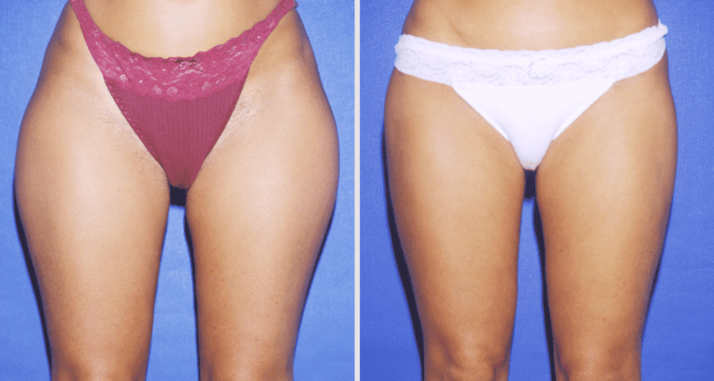 Vorher/Nachher Ergebnis: Fettabsaugung Reiterhosen