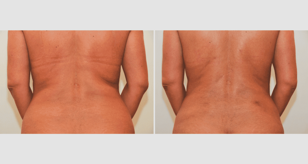 Vorher/Nachher Ergebnis: Fettabsaugung Ruecken