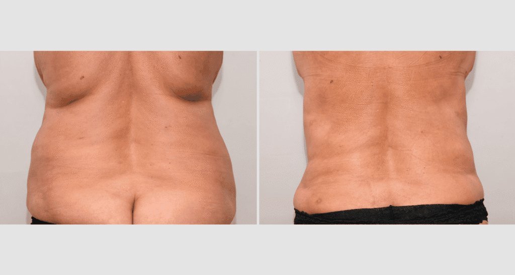 Vorher/Nachher Ergebnis: Fettabsaugung Ruecken
