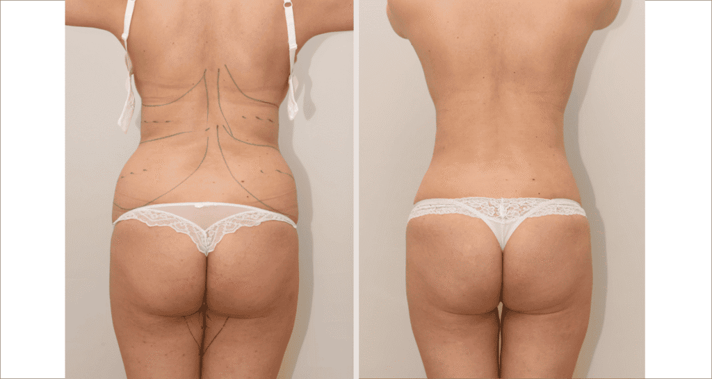 Vorher/Nachher Ergebnis: Fettabsaugung Ruecken