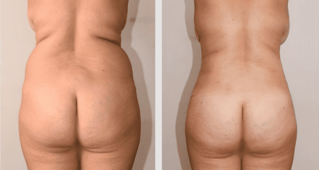 Vorher/Nachher Ergebnis: Fettabsaugung Ruecken