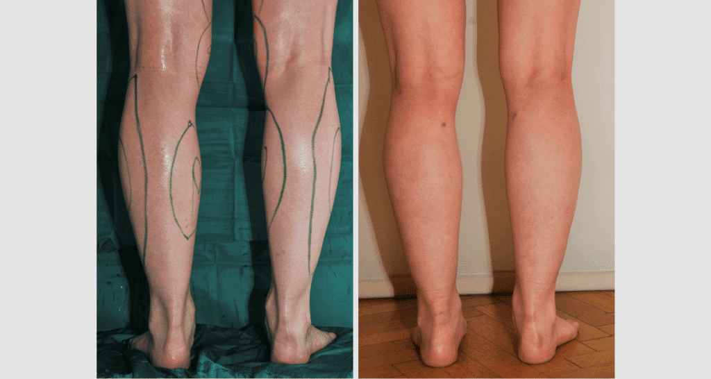 Vorher/Nachher Ergebnis: Fettabsaugung Waden