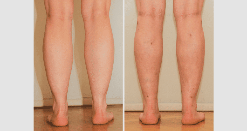 Vorher/Nachher Ergebnis: Fettabsaugung Waden