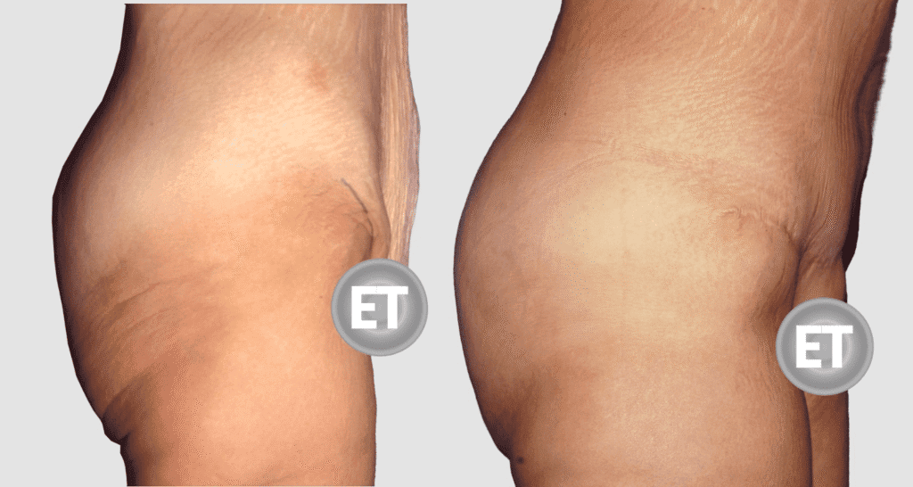 Vorher/Nachher Ergebnis: Gesaessstraffung