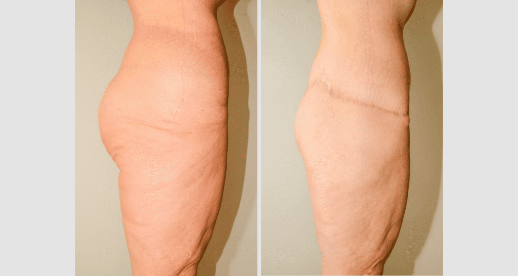 Vorher/Nachher Ergebnis: Gesaessstraffung