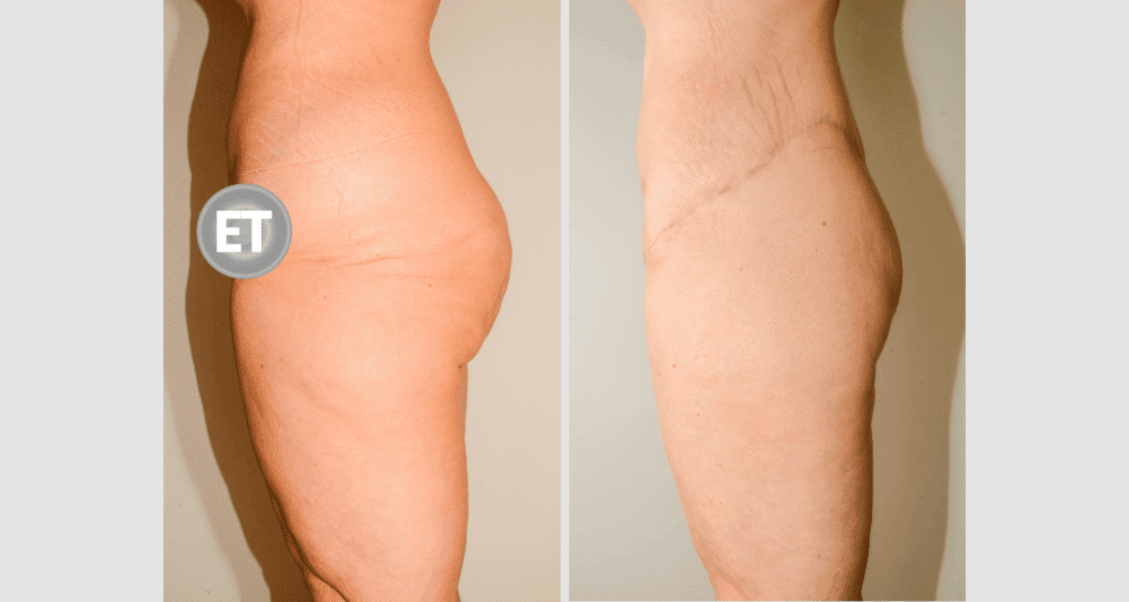 Vorher/Nachher Ergebnis: Gesaessstraffung