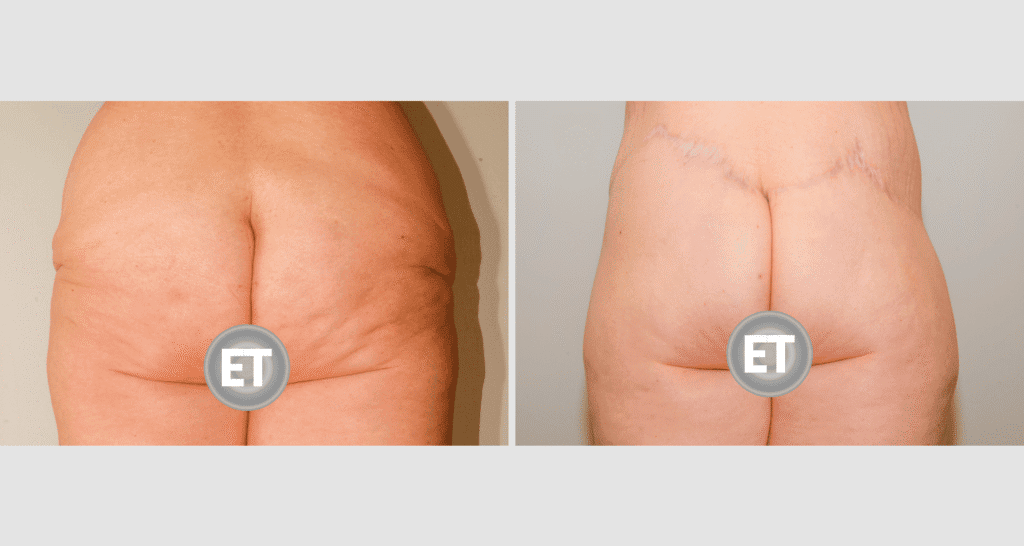 Vorher/Nachher Ergebnis: Gesaessstraffung