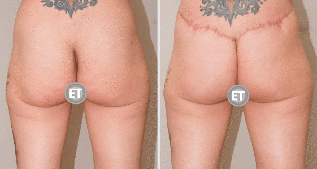 Vorher/Nachher Ergebnis: Gesaessstraffung