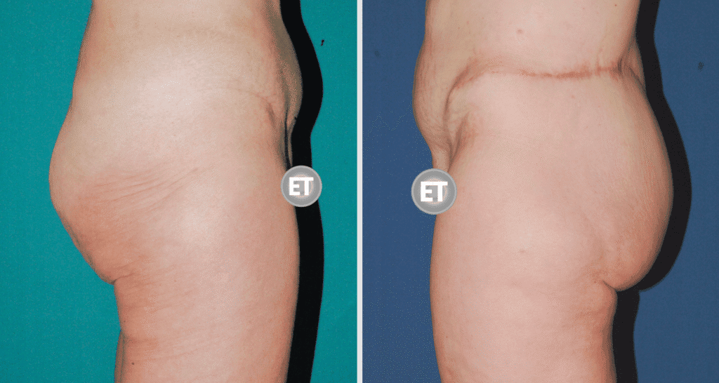 Vorher/Nachher Ergebnis: Gesaessstraffung