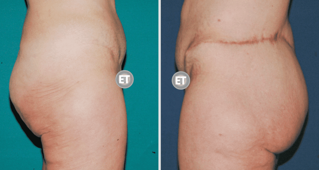 Vorher/Nachher Ergebnis: Gesaessstraffung