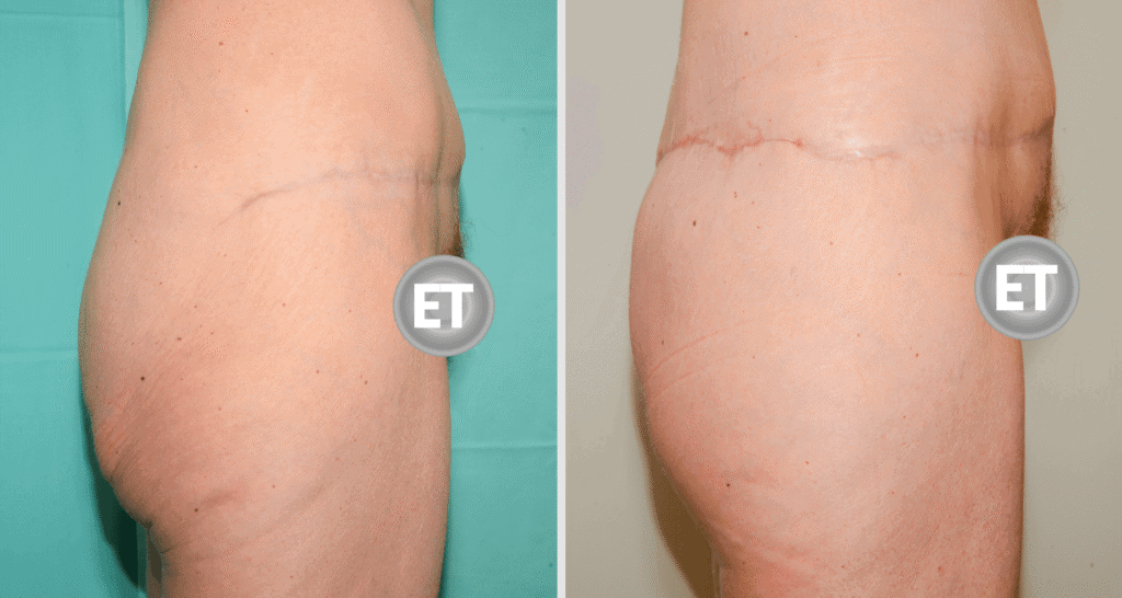 Vorher/Nachher Ergebnis: Gesaessstraffung