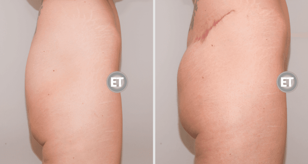 Vorher/Nachher Ergebnis: Gesaessstraffung