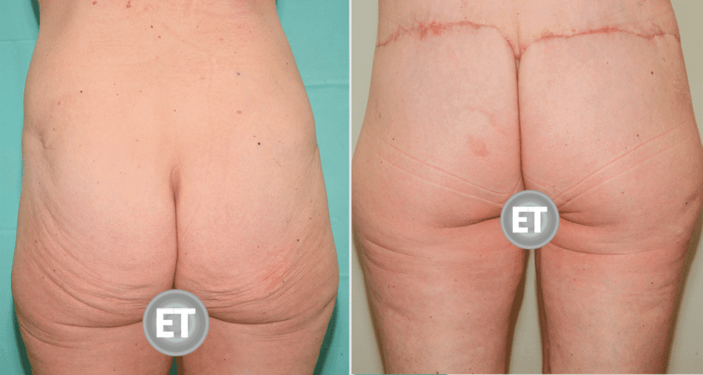 Vorher/Nachher Ergebnis: Gesaessstraffung