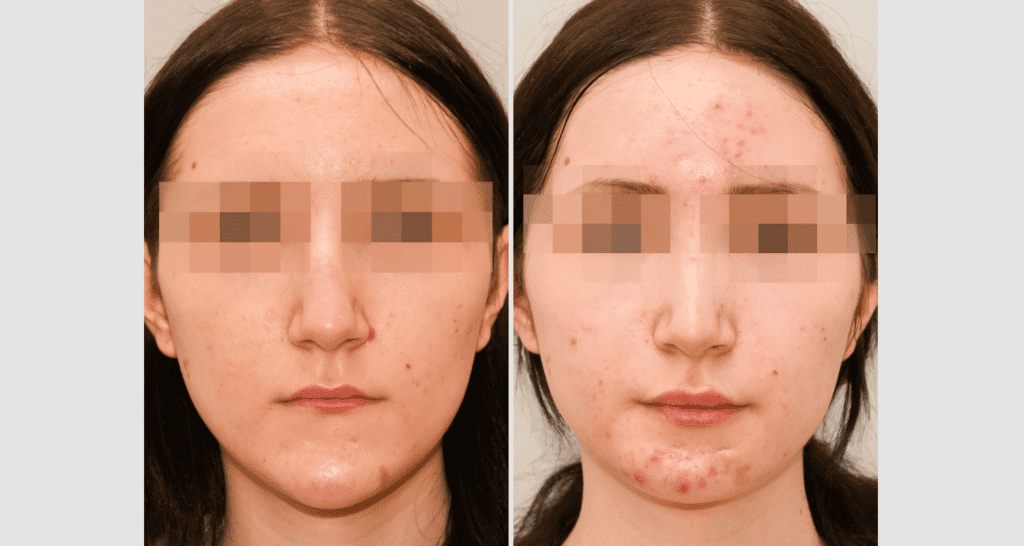 Vorher/Nachher Ergebnis: Kinnkorrektur Reduktion