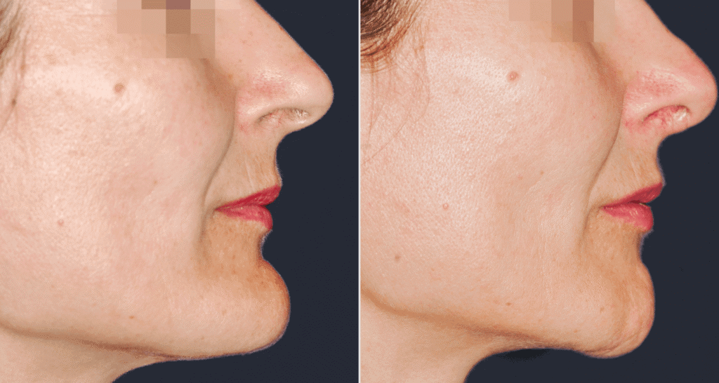 Vorher/Nachher Ergebnis: Kinnkorrektur Reduktion