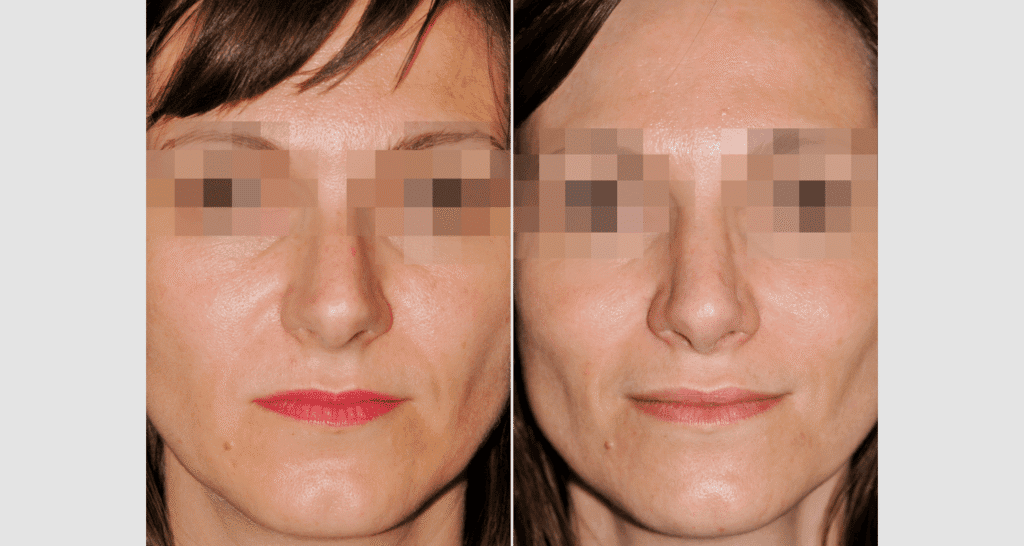 Vorher/Nachher Ergebnis: Kinnkorrektur Reduktion