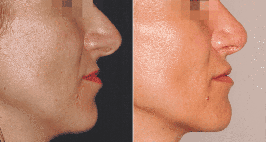 Vorher/Nachher Ergebnis: Kinnkorrektur Reduktion