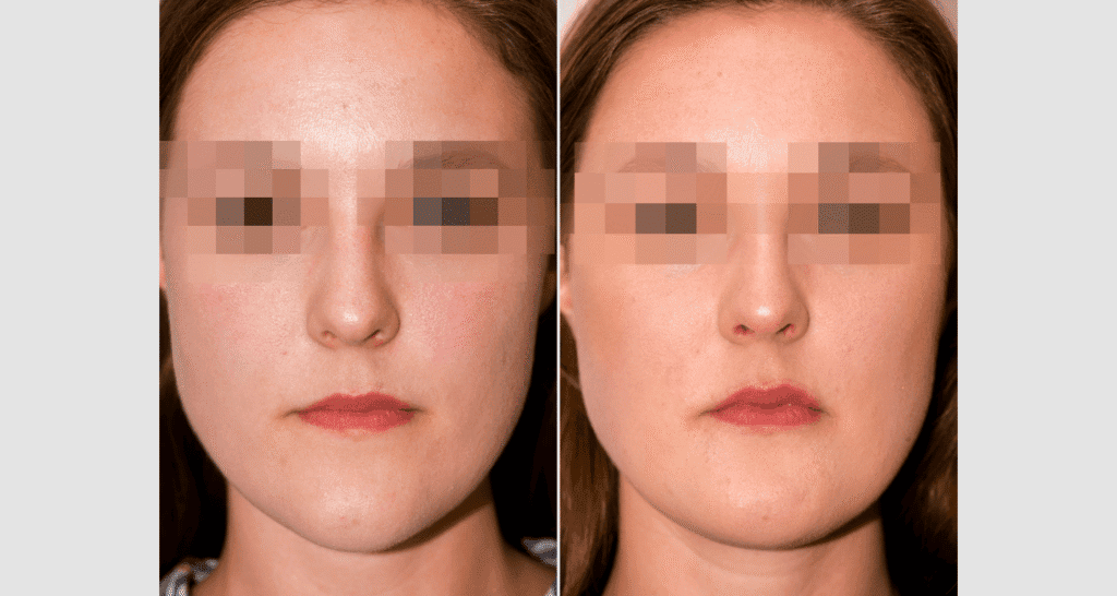 Vorher/Nachher Ergebnis: Kinnkorrektur Reduktion