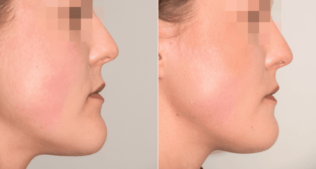 Vorher/Nachher Ergebnis: Kinnkorrektur Reduktion