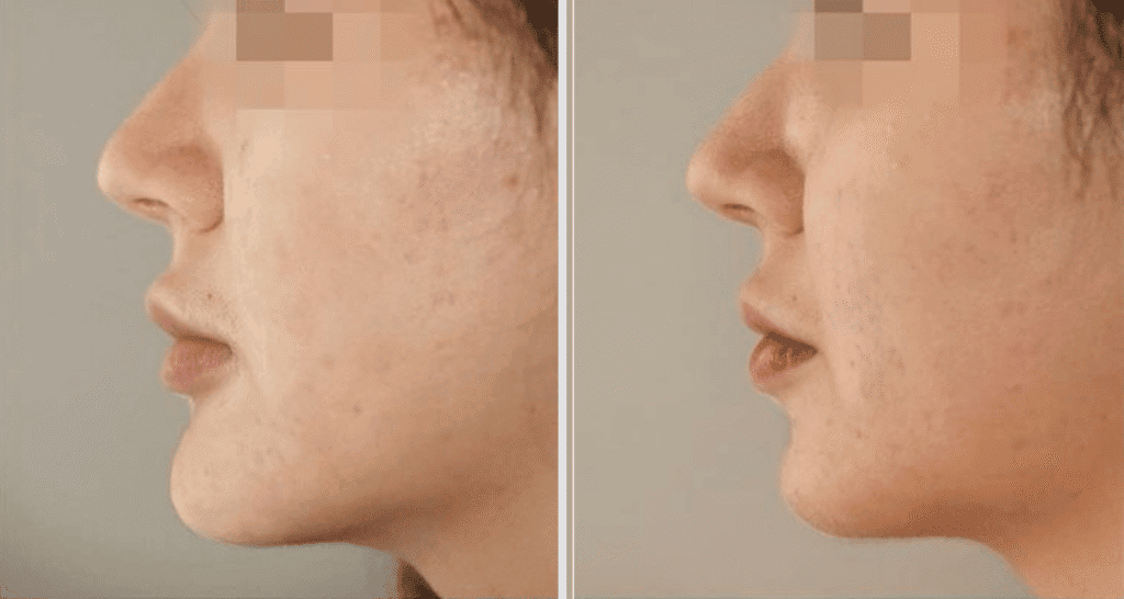 Vorher/Nachher Ergebnis: Kinnkorrektur Reduktion