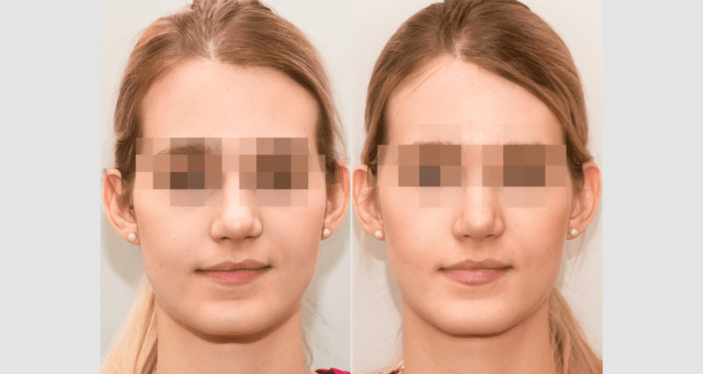 Vorher/Nachher Ergebnis: Kinnkorrektur Reduktion