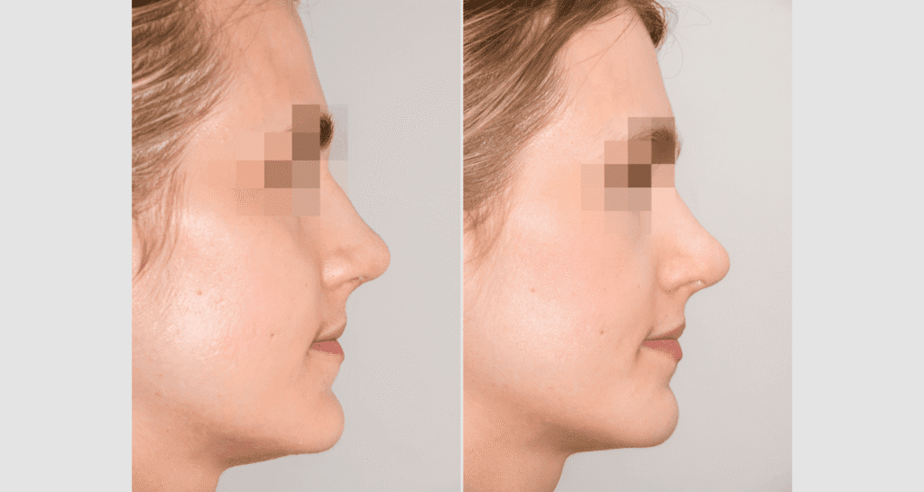 Vorher/Nachher Ergebnis: Kinnkorrektur Reduktion