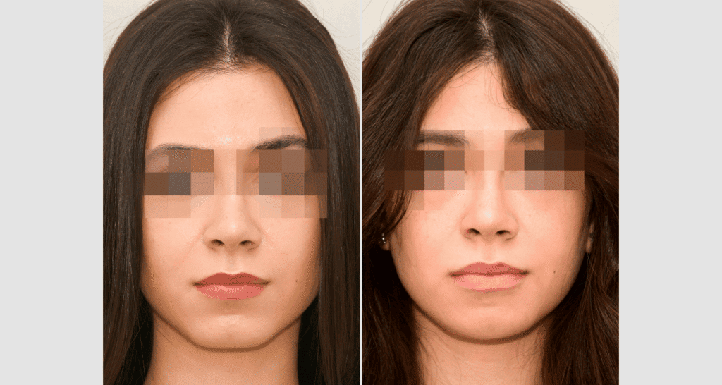 Vorher/Nachher Ergebnis: Kinnkorrektur Reduktion