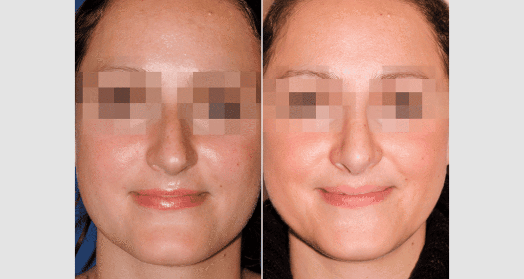 Vorher/Nachher Ergebnis: Kinnkorrektur Reduktion