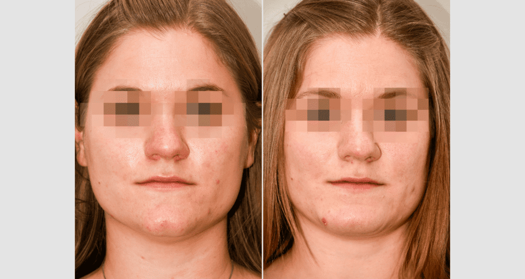 Vorher/Nachher Ergebnis: Kinnkorrektur Reduktion