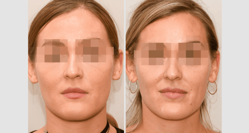 Vorher/Nachher Ergebnis: Kinnkorrektur Reduktion