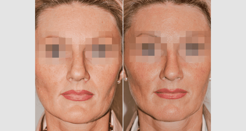 Vorher/Nachher Ergebnis: Kinnkorrektur Reduktion