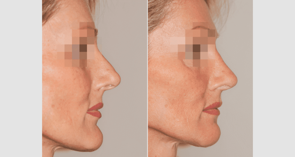 Vorher/Nachher Ergebnis: Kinnkorrektur Reduktion