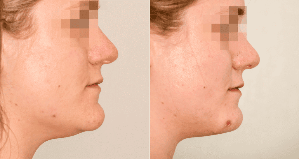 Vorher/Nachher Ergebnis: Kinnkorrektur Reduktion