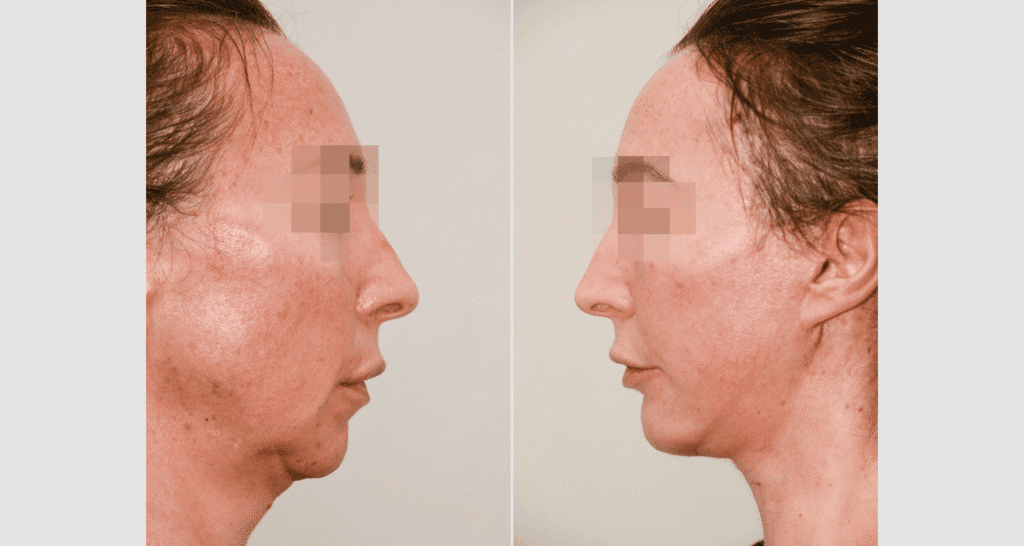 Vorher/Nachher Ergebnis: Kinnkorrektur Vergroesserung