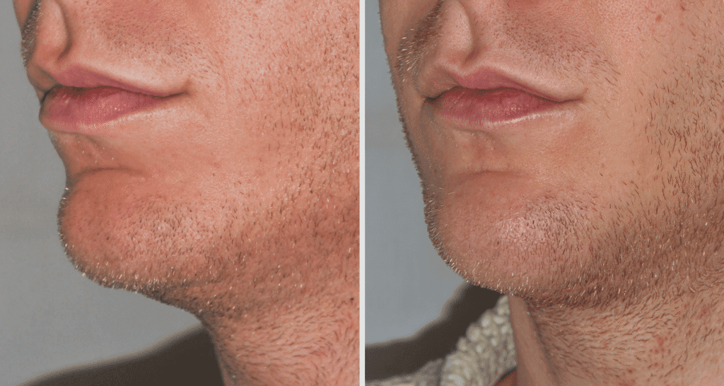 Vorher/Nachher Ergebnis: Kinnkorrektur Vergroesserung