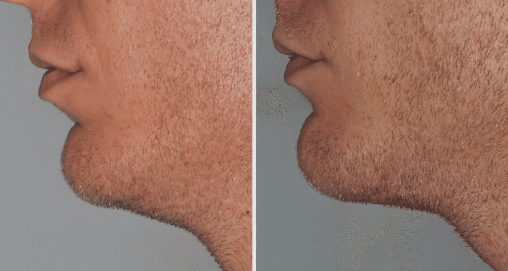 Vorher/Nachher Ergebnis: Kinnkorrektur Vergroesserung