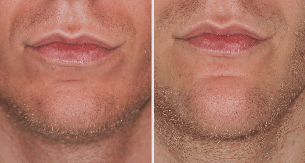 Vorher/Nachher Ergebnis: Kinnkorrektur Vergroesserung