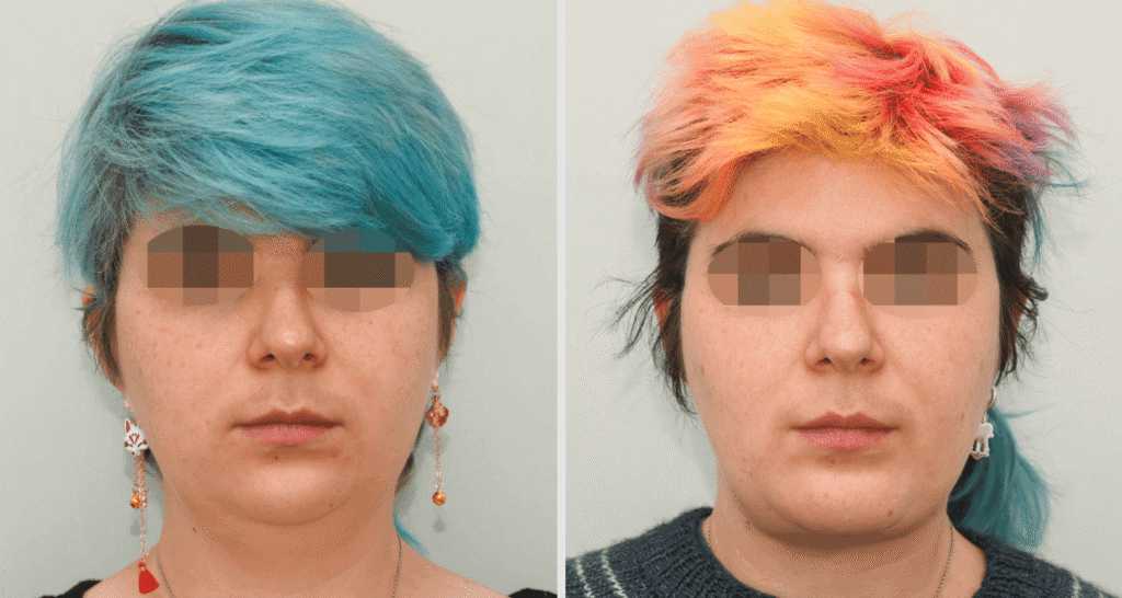 Vorher/Nachher Ergebnis: Kinnkorrektur Vergroesserung